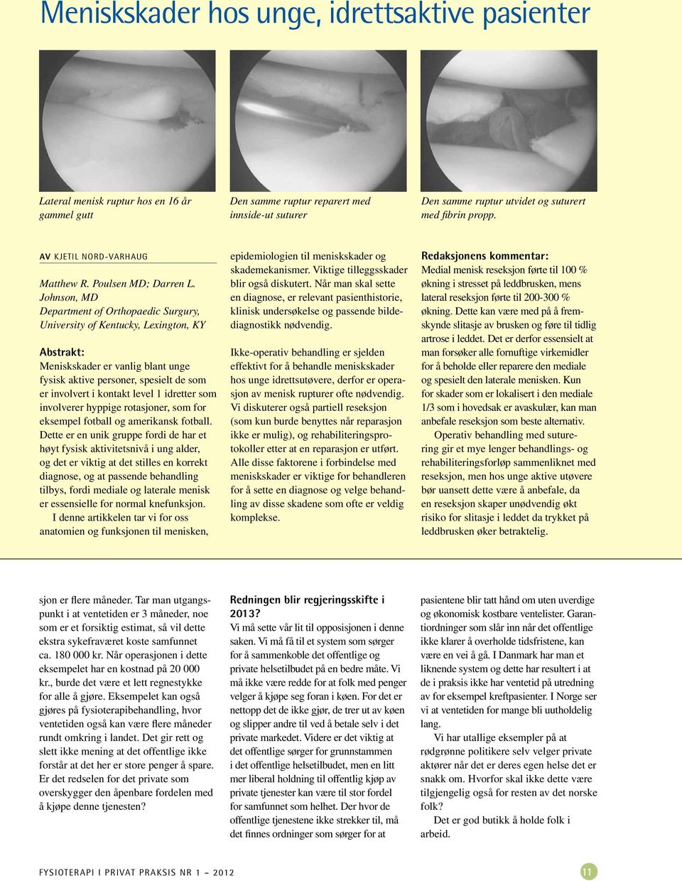 Johnson, MD Department of Orthopaedic Surgury, University of Kentucky, Lexington, KY Abstrakt: Meniskskader er vanlig blant unge fysisk aktive personer, spesielt de som er involvert i kontakt level 1