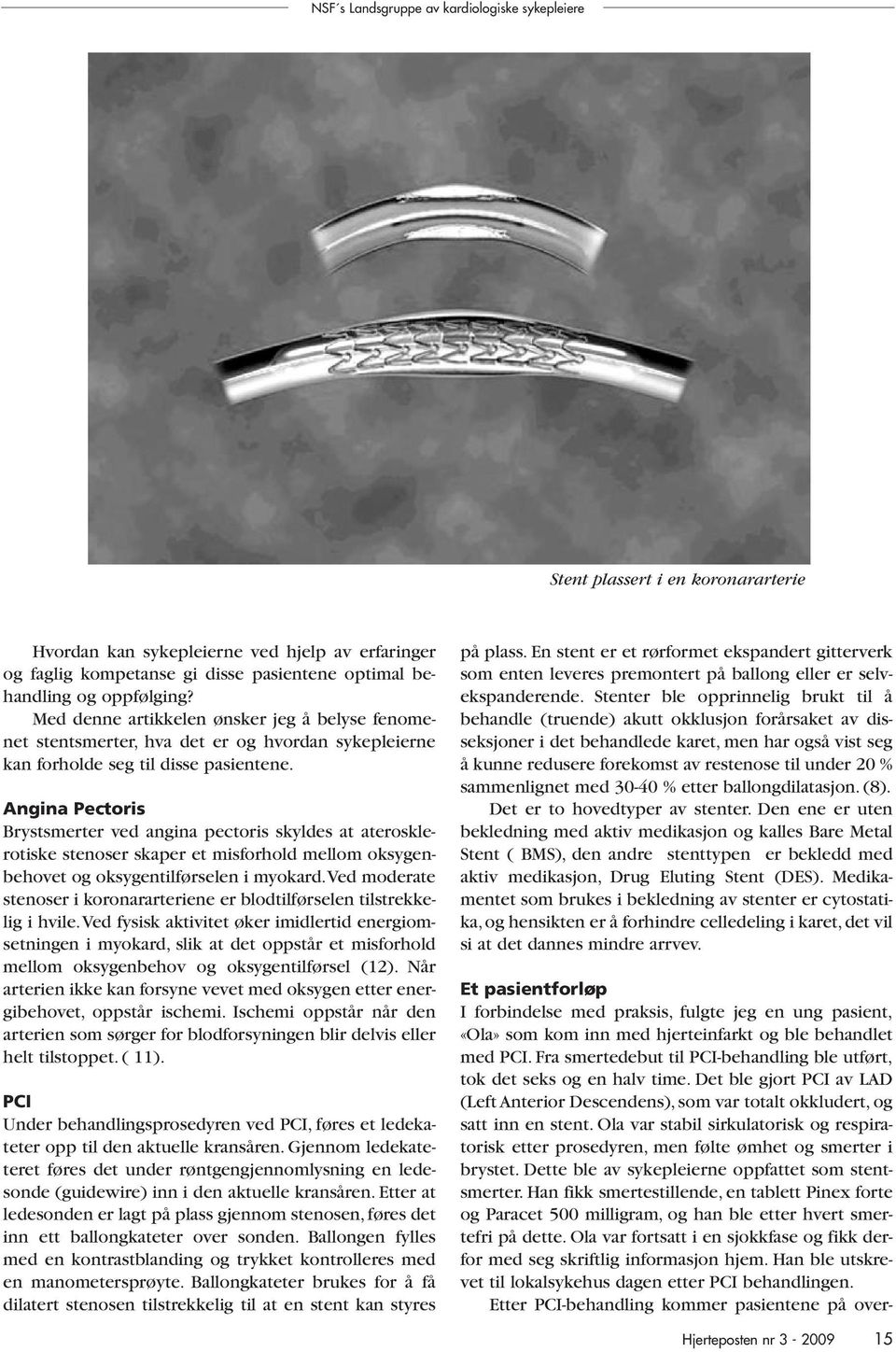 Angina Pectoris Brystsmerter ved angina pectoris skyldes at aterosklerotiske stenoser skaper et misforhold mellom oksygenbehovet og oksygentilførselen i myokard.