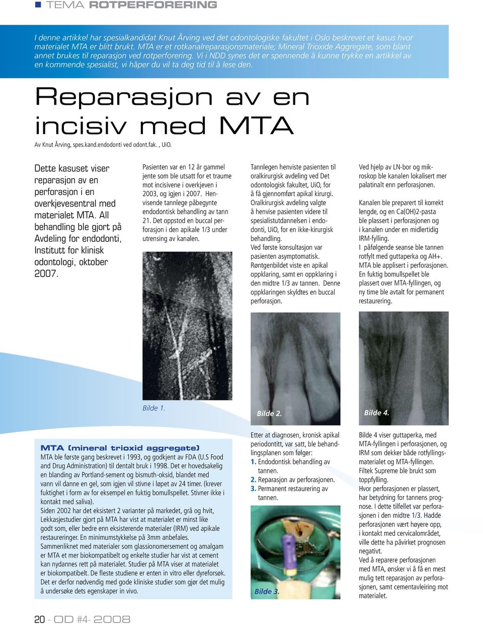 Vi i NDD synes det er spennende å kunne trykke en artikkel av en kommende spesialist, vi håper du vil ta deg tid til å lese den. Reparasjon av en incisiv med MTA Av Knut Årving, spes.kand.