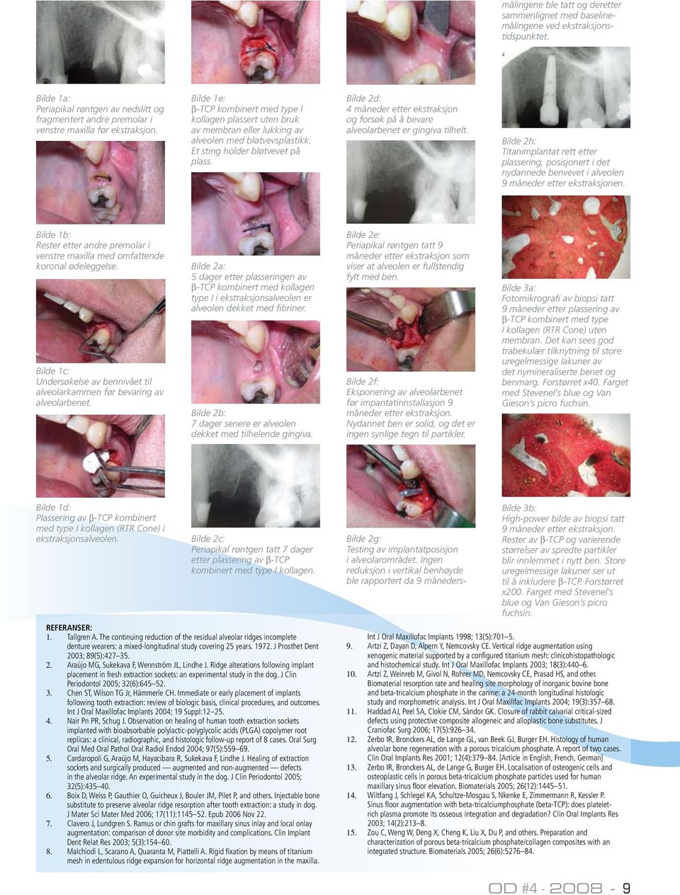 Bilde 2d: 4 måneder etter ekstraksjon og forsøk på å bevare alveolarbenet er gingiva tilhelt.