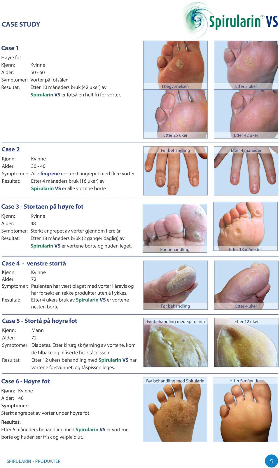 uker Etter 42 uker Etter 4 måneder Case 3 - Stortåen på høyre fot Alder: 48 Symptomer: Sterkt angrepet av vorter gjennom flere år Resultat: Etter 18 måneders bruk (2 ganger daglig) av Spirularin VS