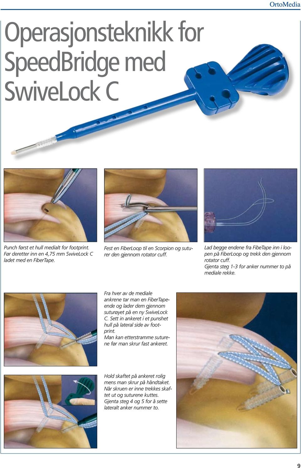 Gjenta steg 1-3 for anker nummer to på mediale rekke. Fra hver av de mediale ankrene tar man en FiberTapeende og lader dem gjennom suturøyet på en ny SwiveLock C.