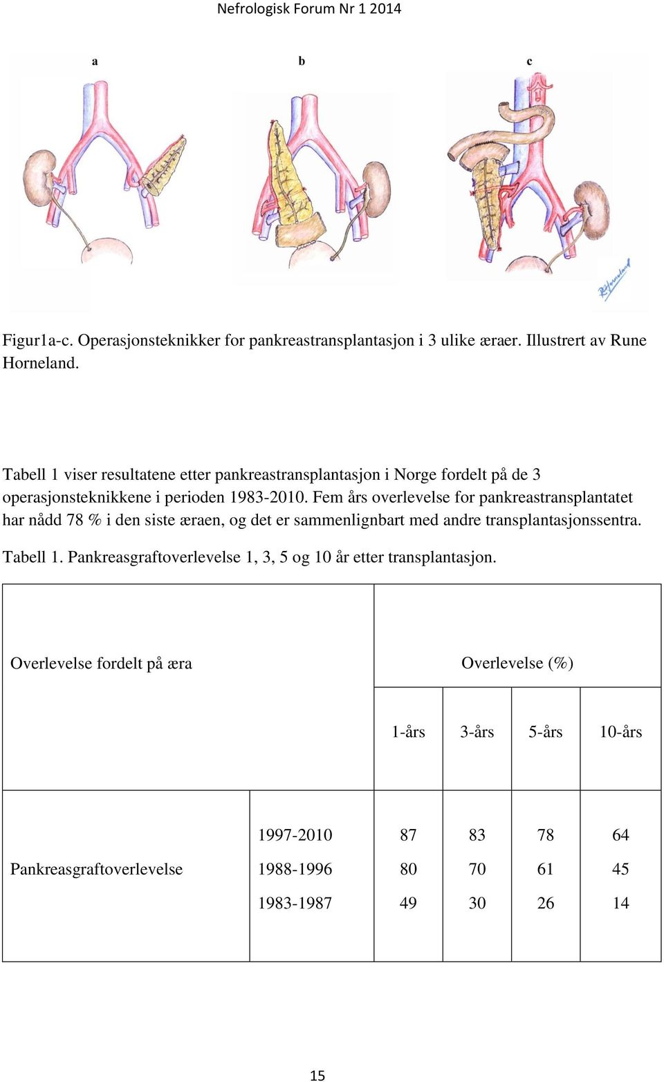 Fem års overlevelse for pankreastransplantatet har nådd 78 % i den siste æraen, og det er sammenlignbart med andre transplantasjonssentra. Tabell 1.