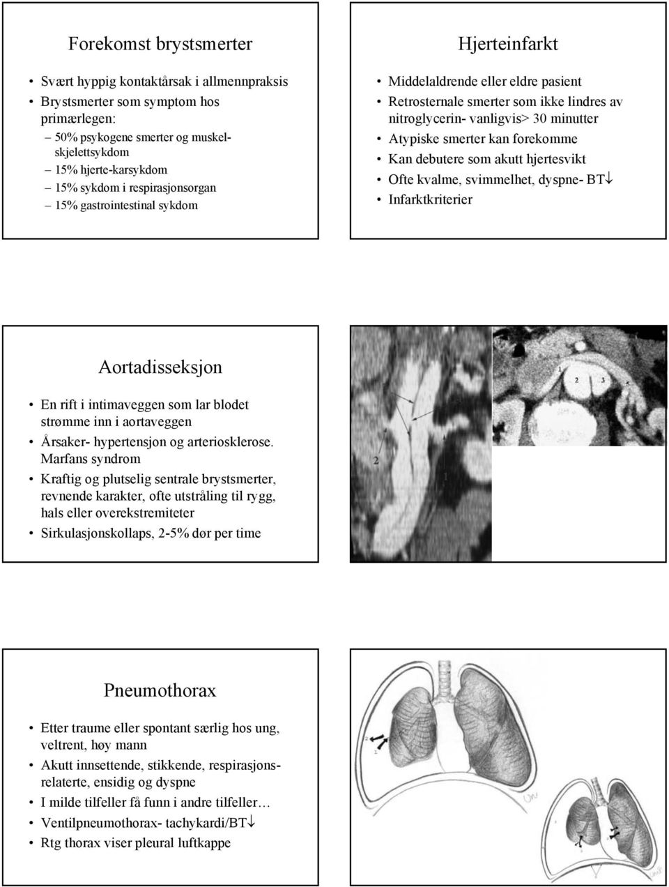 forekomme Kan debutere som akutt hjertesvikt Ofte kvalme, svimmelhet, dyspne- BT Infarktkriterier Aortadisseksjon En rift i intimaveggen som lar blodet strømme inn i aortaveggen Årsaker- hypertensjon