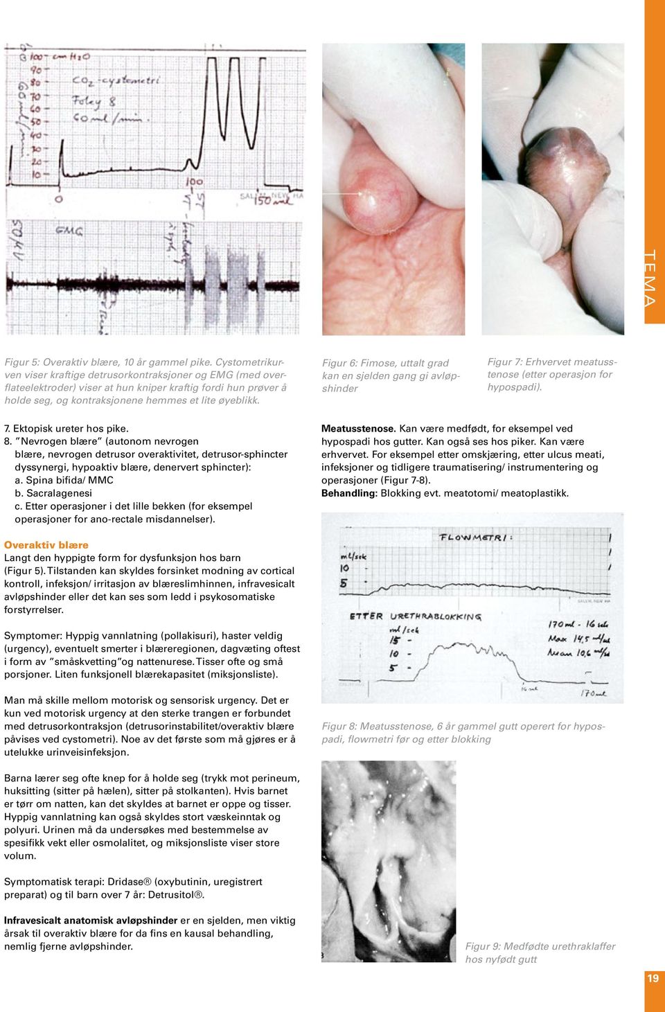 Figur 6: Fimose, uttalt grad kan en sjelden gang gi avløpshinder Figur 7: Erhvervet meatusstenose (etter operasjon for hypospadi). 7. Ektopisk ureter hos pike. 8.