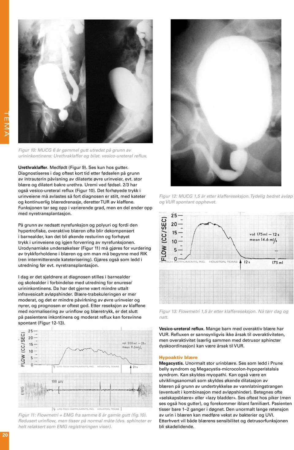 2/3 har også vesico-ureteral reflux (Figur 10). Det forhøyede trykk i urinveiene må avlastes så fort diagnosen er stilt, med kateter og kontinuerlig blæredrenasje, deretter TUR av klaffene.