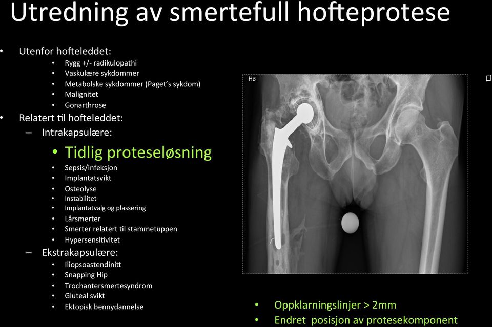 Osteolyse Instabilitet Implantatvalg og plassering Lårsmerter Smerter relatert Hl stammetuppen HypersensiHvitet Ekstrakapsulære: