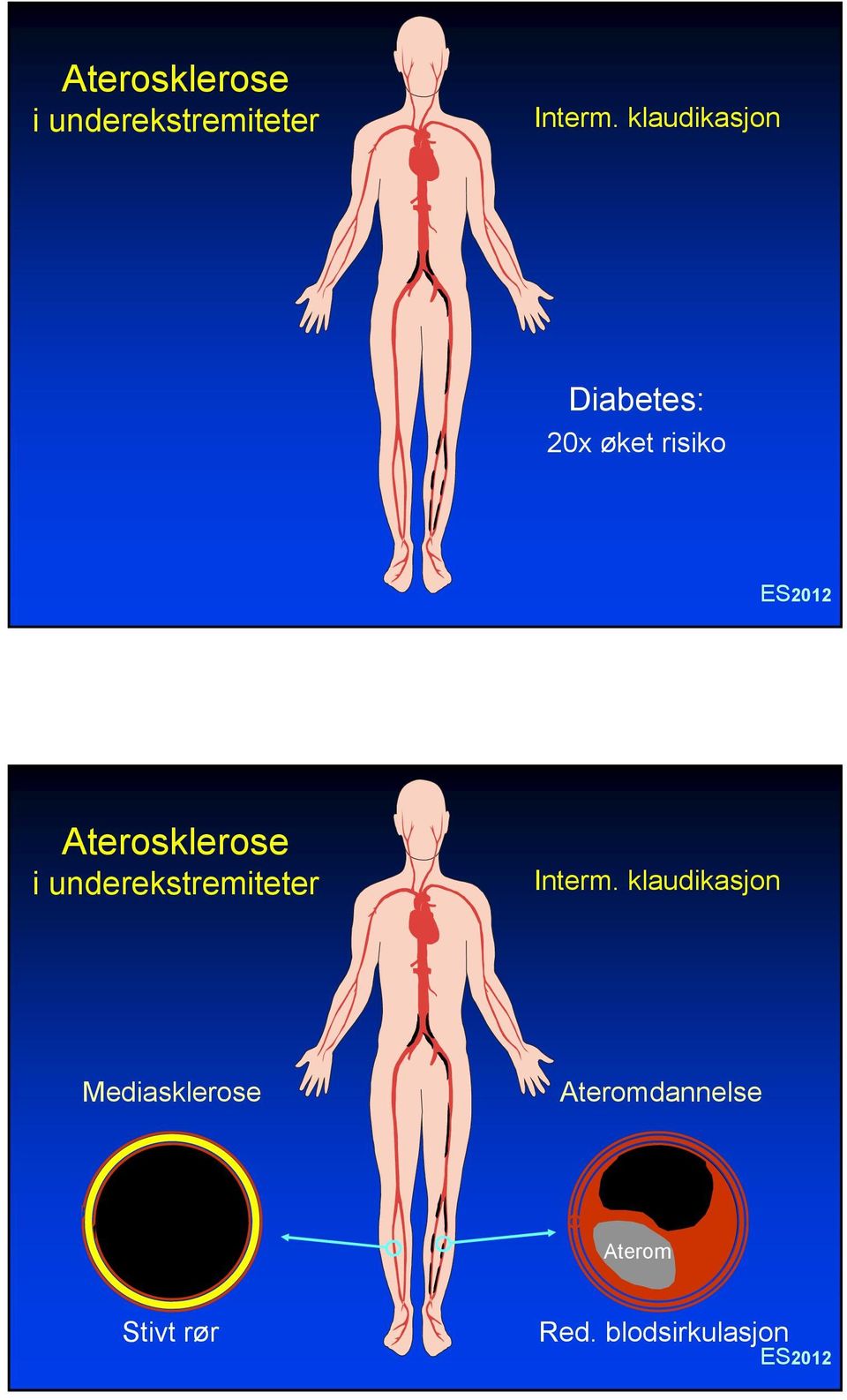 klaudikasjon Mediasklerose Ateromdannelse Aterom