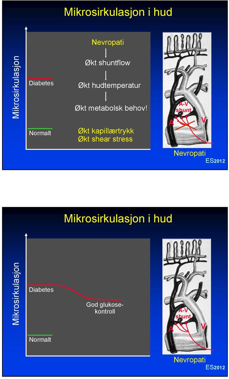 Økt kapillærtrykk Økt shear stress A A-V shunt V Nevropati