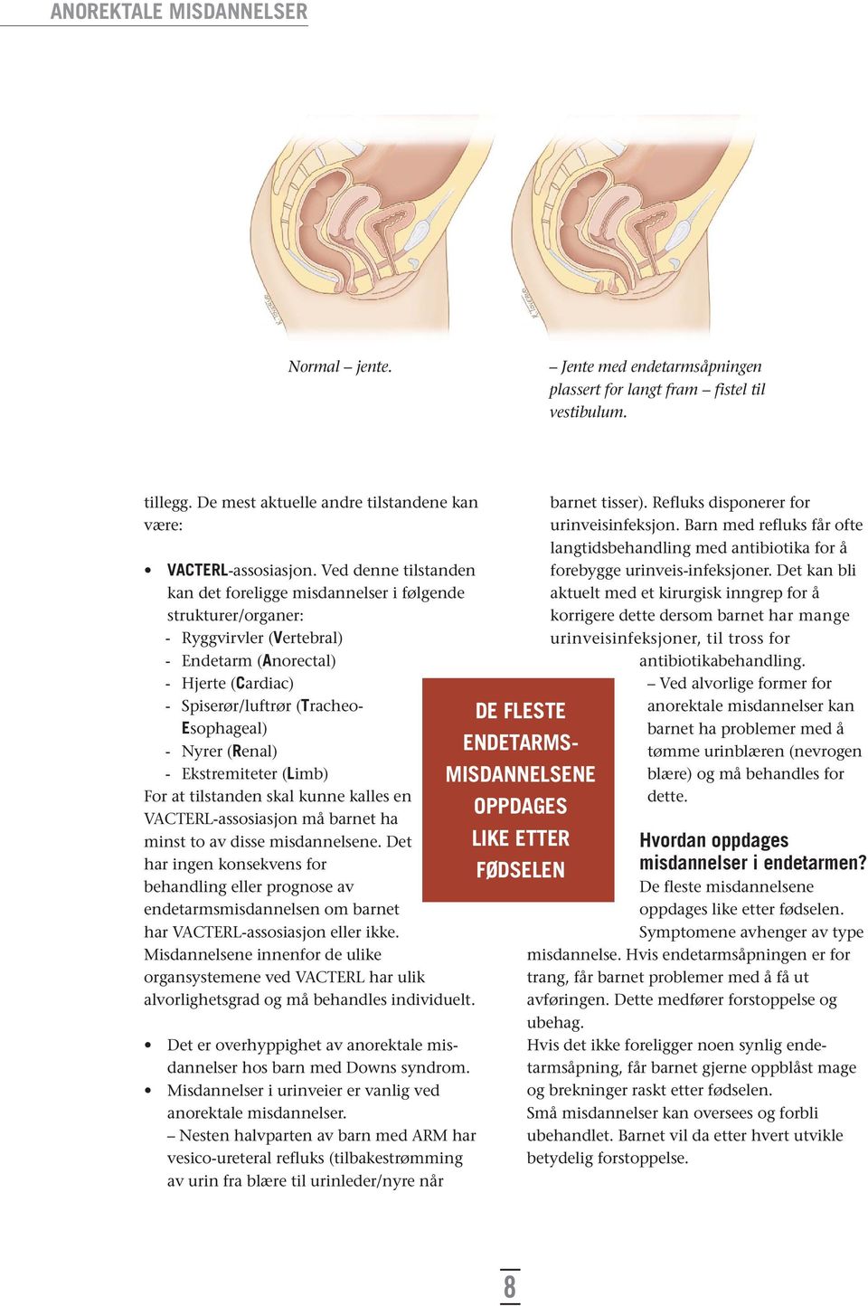 (Renal) - Ekstremiteter (Limb) For at tilstanden skal kunne kalles en VACTERL-assosiasjon må barnet ha minst to av disse misdannelsene.