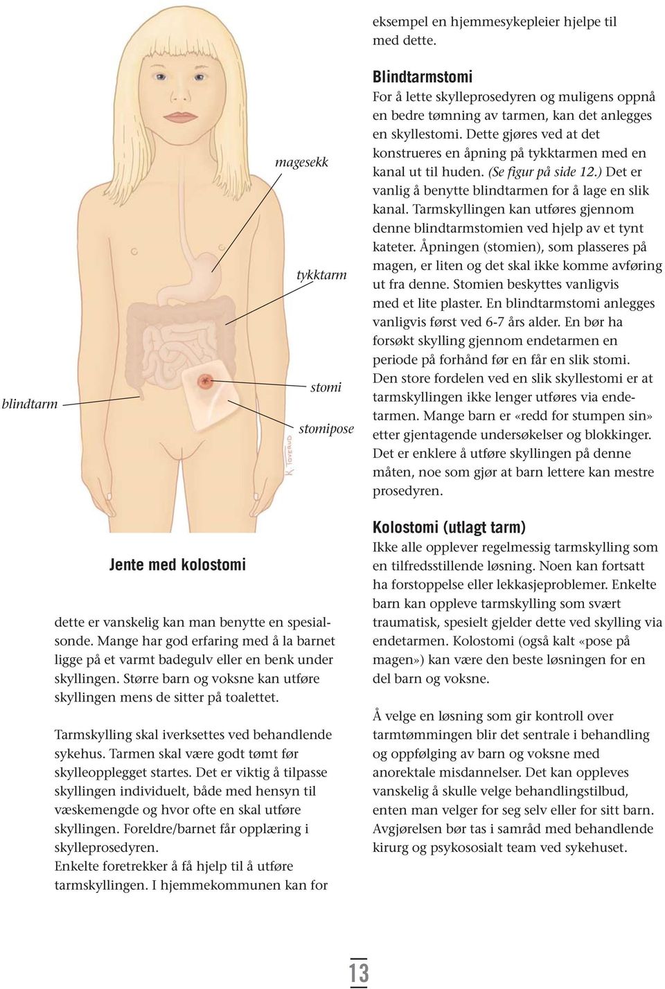 Dette gjøres ved at det konstrueres en åpning på tykktarmen med en kanal ut til huden. (Se figur på side 12.) Det er vanlig å benytte blindtarmen for å lage en slik kanal.