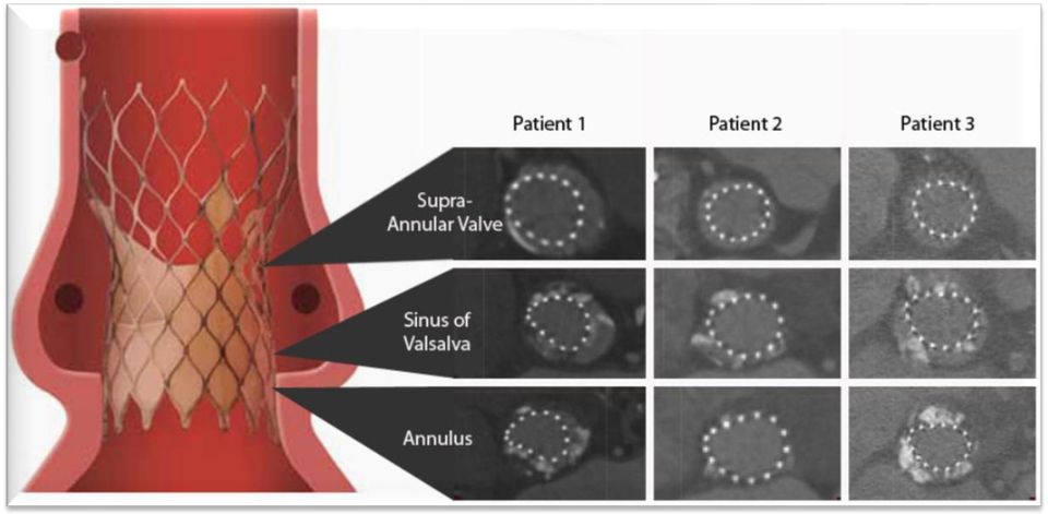 decoupling of the valve from native annulus shape minimizes the impact