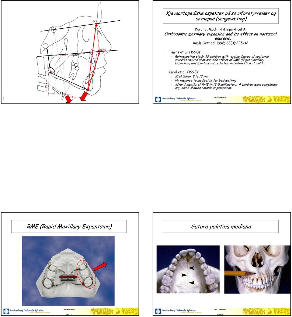 10 children with varying degree of nocturnal enuresis showed that one side effect of RME (Rapid Maxillary Expansion) was spontaneous reduction in bed-wetting at night.