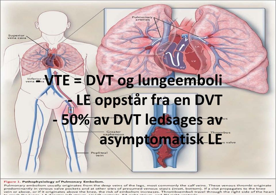 oppstår fra en DVT