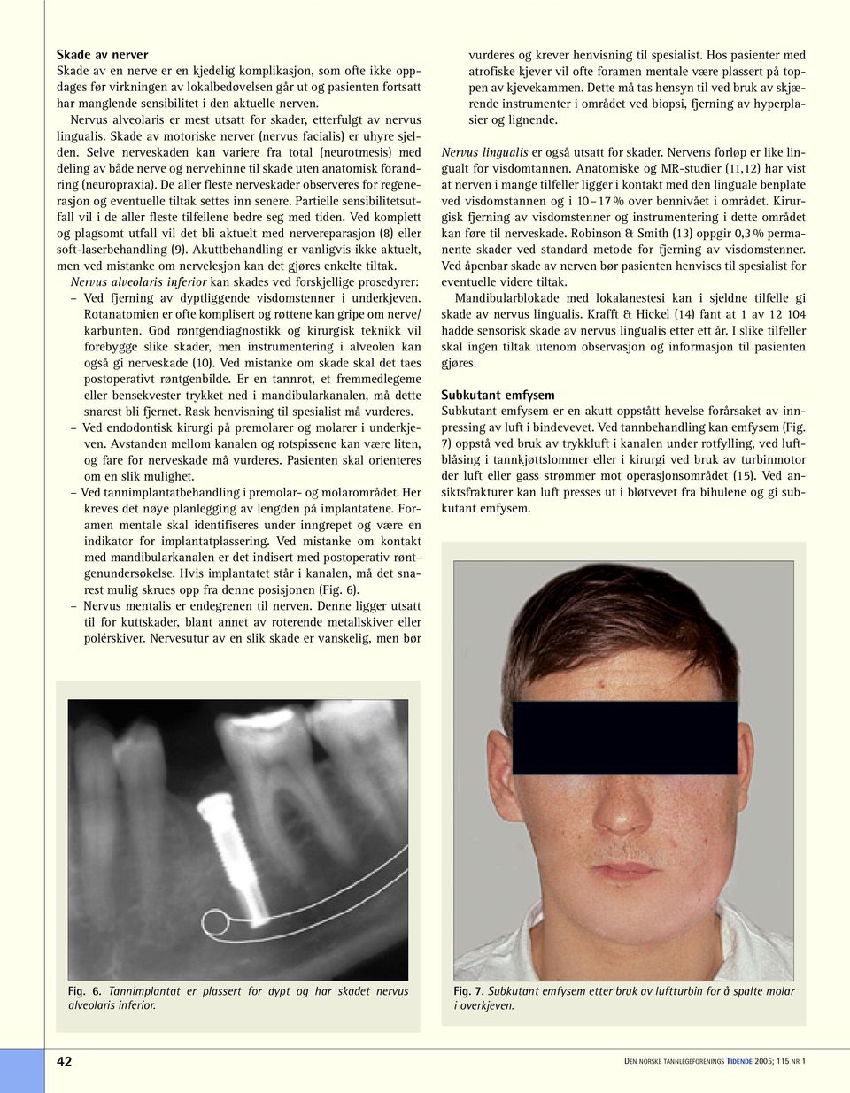 Selve nerveskaden kan variere fra total (neurotmesis) med deling av både nerve og nervehinne til skade uten anatomisk forandring (neuropraxia).