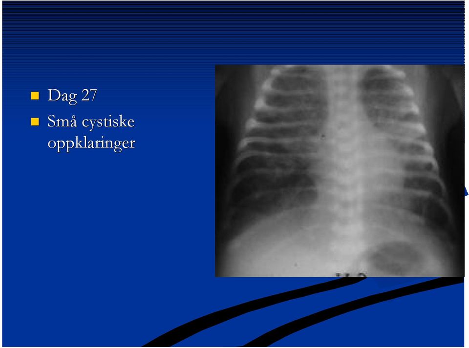 cystiske