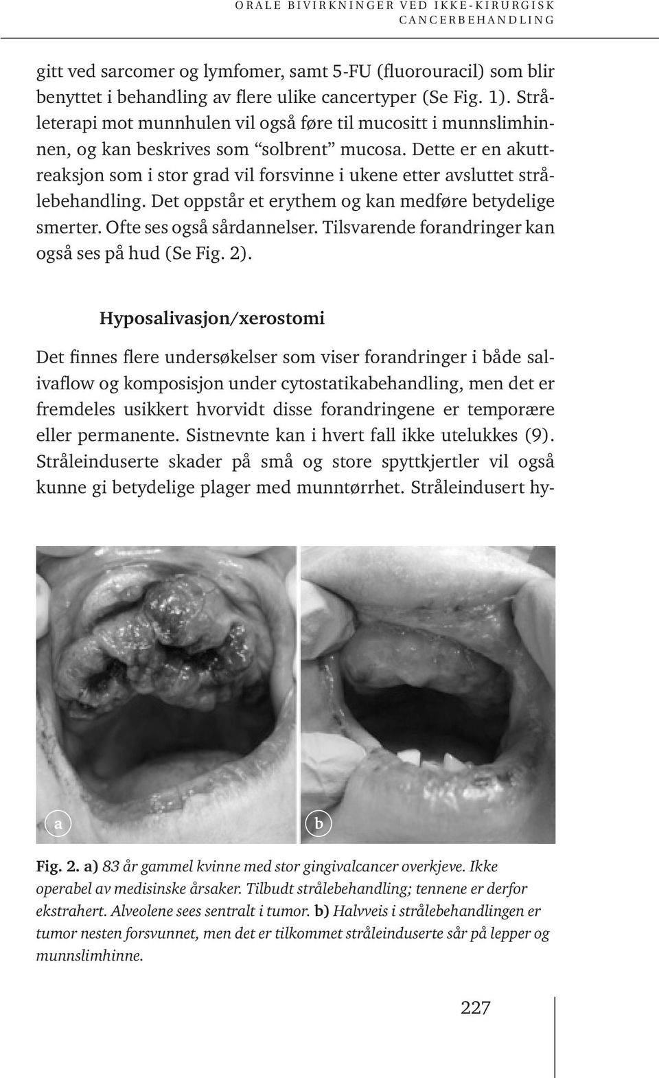 Dette er en akuttreaksjon som i stor grad vil forsvinne i ukene etter avsluttet strålebehandling. Det oppstår et erythem og kan medføre betydelige smerter. Ofte ses også sårdannelser.