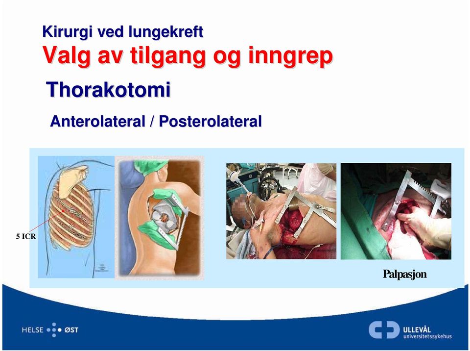 Thorakotomi Anterolateral