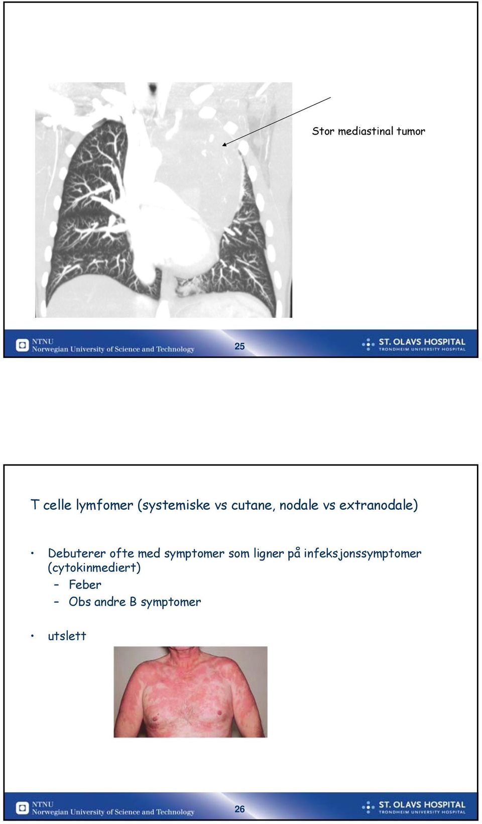 Debuterer ofte med symptomer som ligner på