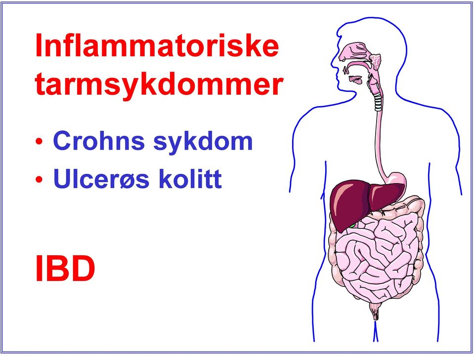 Crohns sykdom