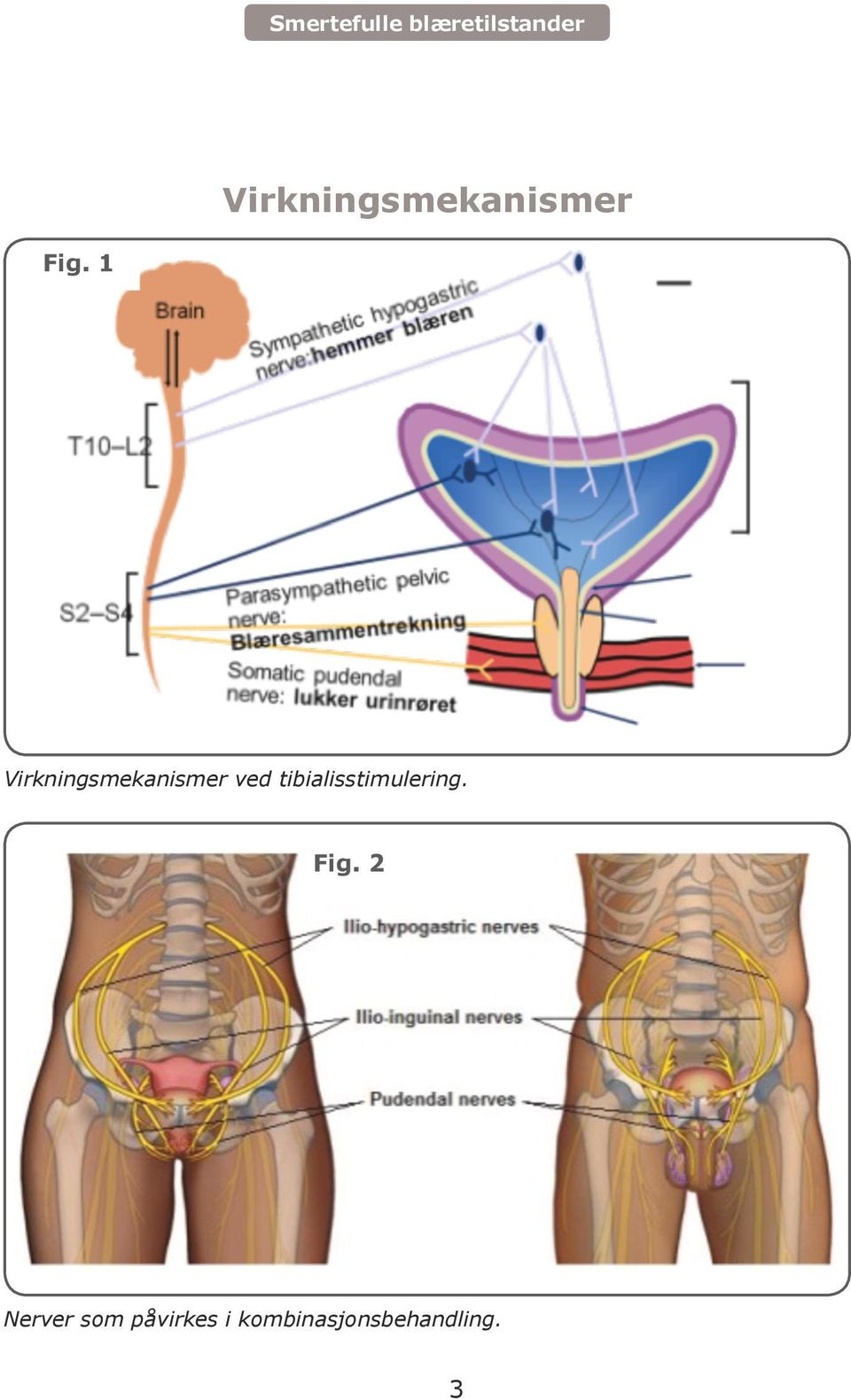 tibialisstimulering. Fig.