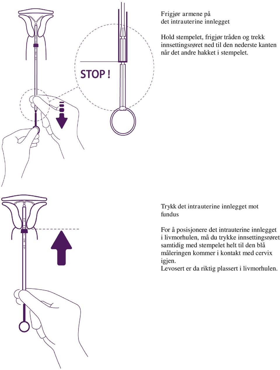 Trykk det intrauterine innlegget mot fundus For å posisjonere det intrauterine innlegget i livmorhulen, må