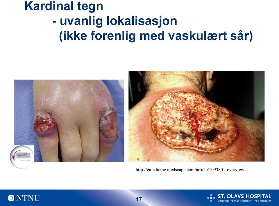 vaskulært sår) http://emedicine.