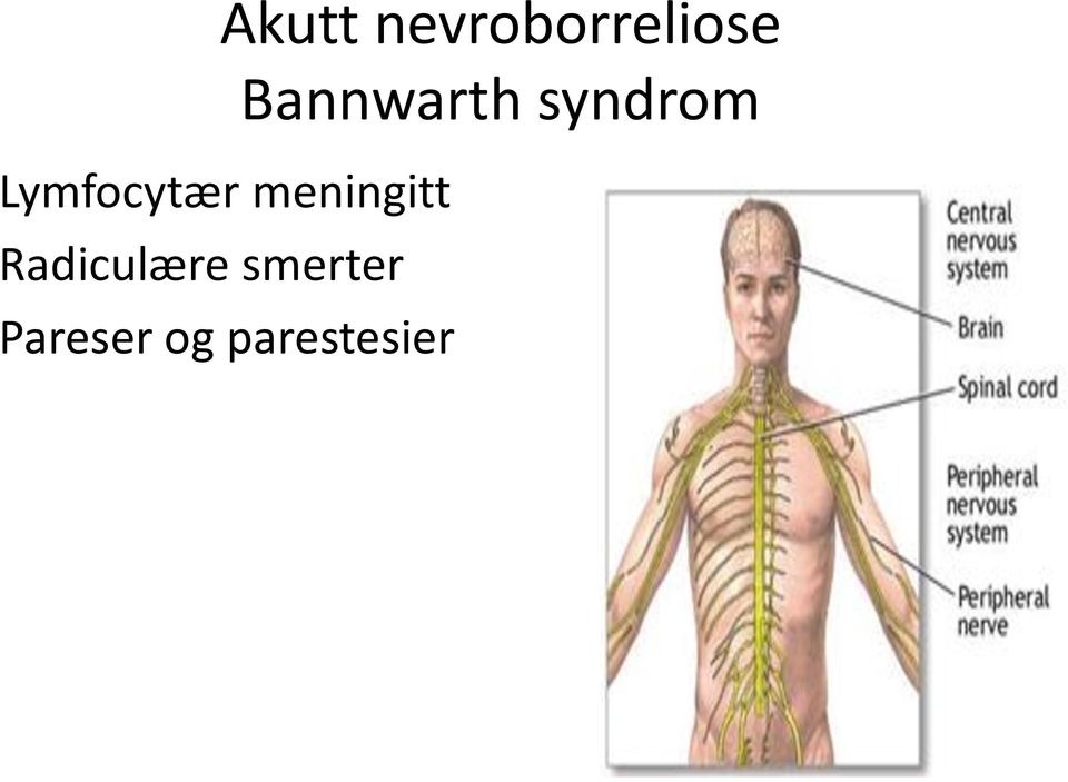 Lymfocytær meningitt