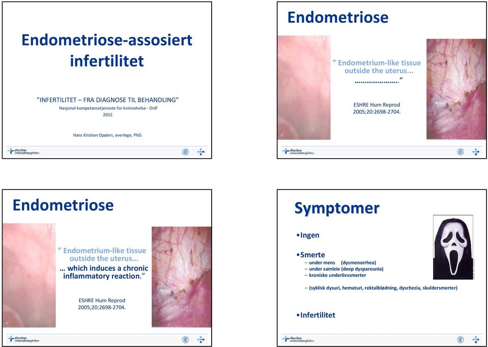 Hans Kristian Opøien, overlege, PhD. Endometriose Symptomer Ingen Endometrium like tissue outside the uterus.