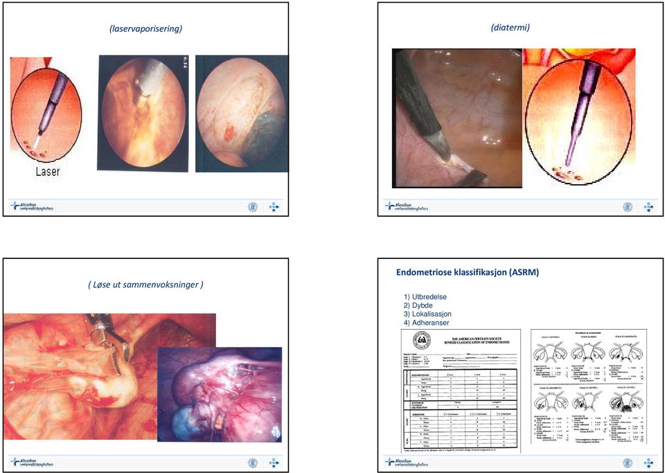 Endometriose klassifikasjon (ASRM)