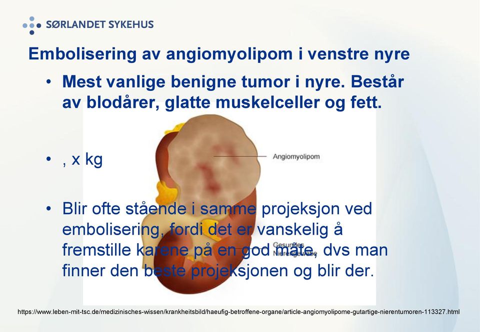 , x kg Blir ofte stående i samme projeksjon ved embolisering, fordi det er vanskelig å fremstille karene på en