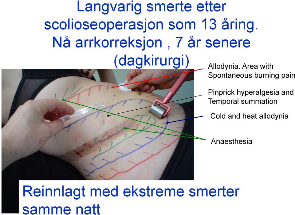 Area with Spontaneous burning pain Pinprick hyperalgesia and