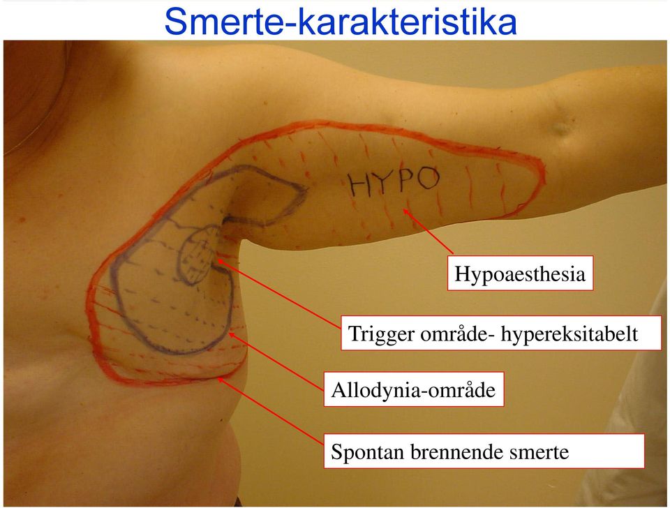 område- hypereksitabelt