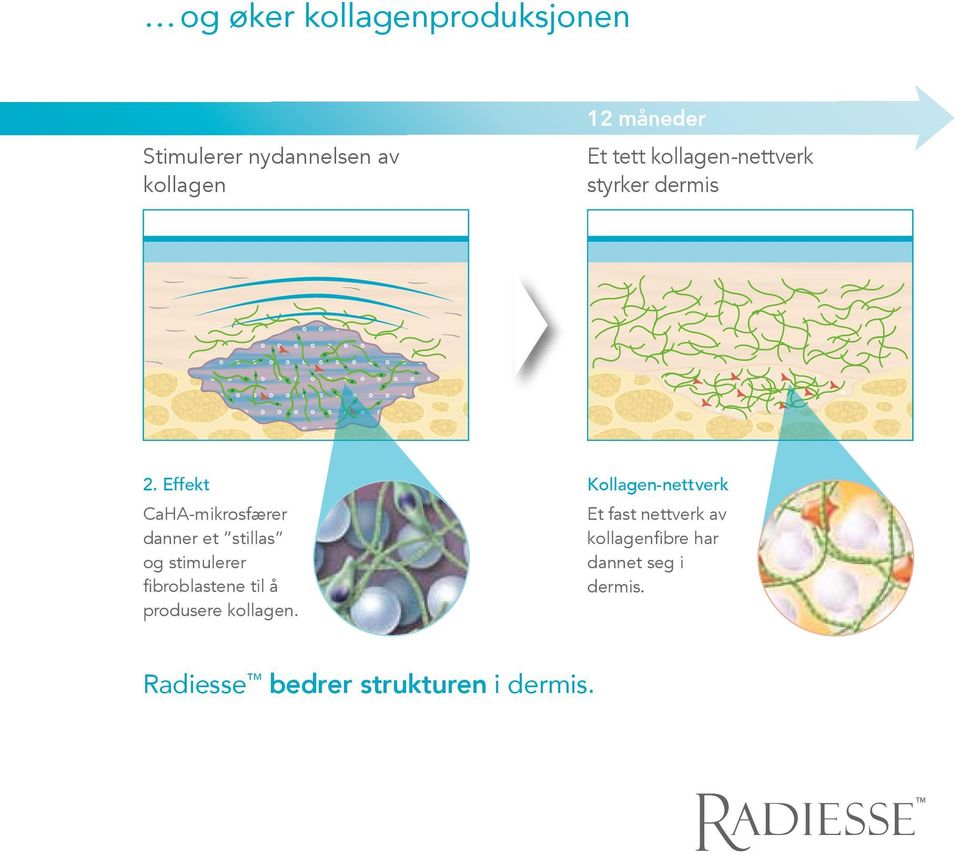 Effekt CaHA-mikrosfærer danner et stillas og stimulerer fibroblastene til å