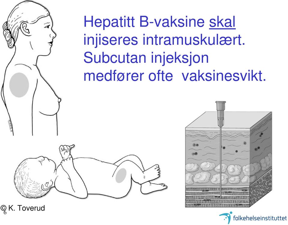 Subcutan injeksjon medfører