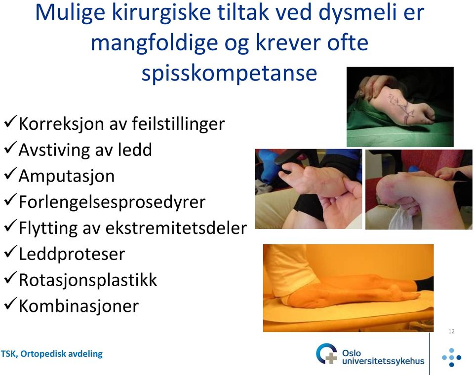 Amputasjon Forlengelsesprosedyrer Flytting av ekstremitetsdeler