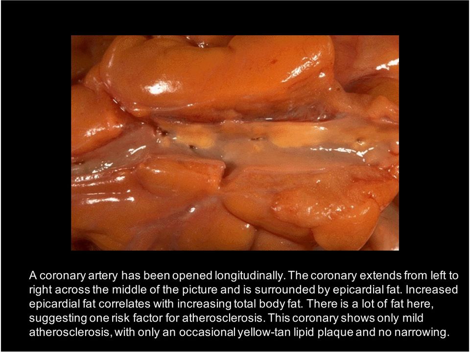 epicardial fat. Increased epicardial fat correlates with increasing total body fat.