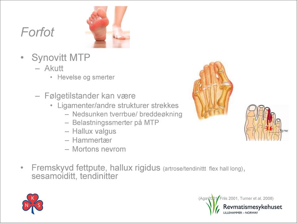 Belastningssmerter på MTP Hallux valgus Hammertær Mortons nevrom Fremskyvd fettpute,