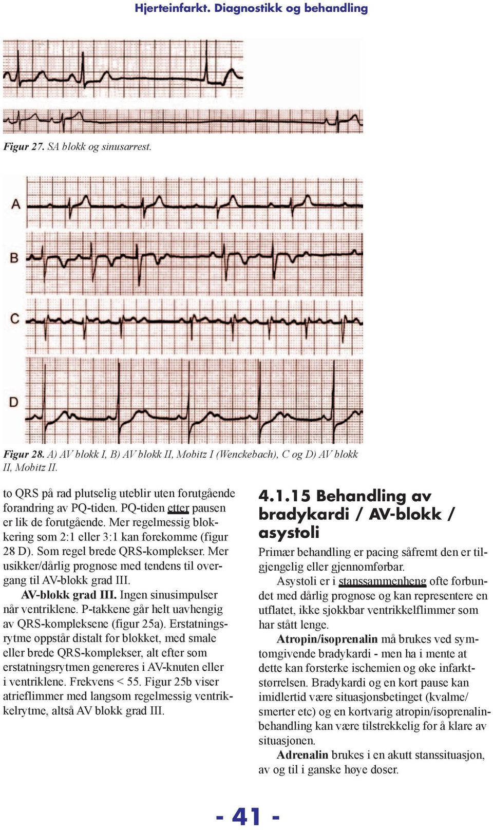 Som regel brede QRS-komplekser. Mer usikker/dårlig prognose med tendens til overgang til AV-blokk grad III. AV-blokk grad III. Ingen sinusimpulser når ventriklene.