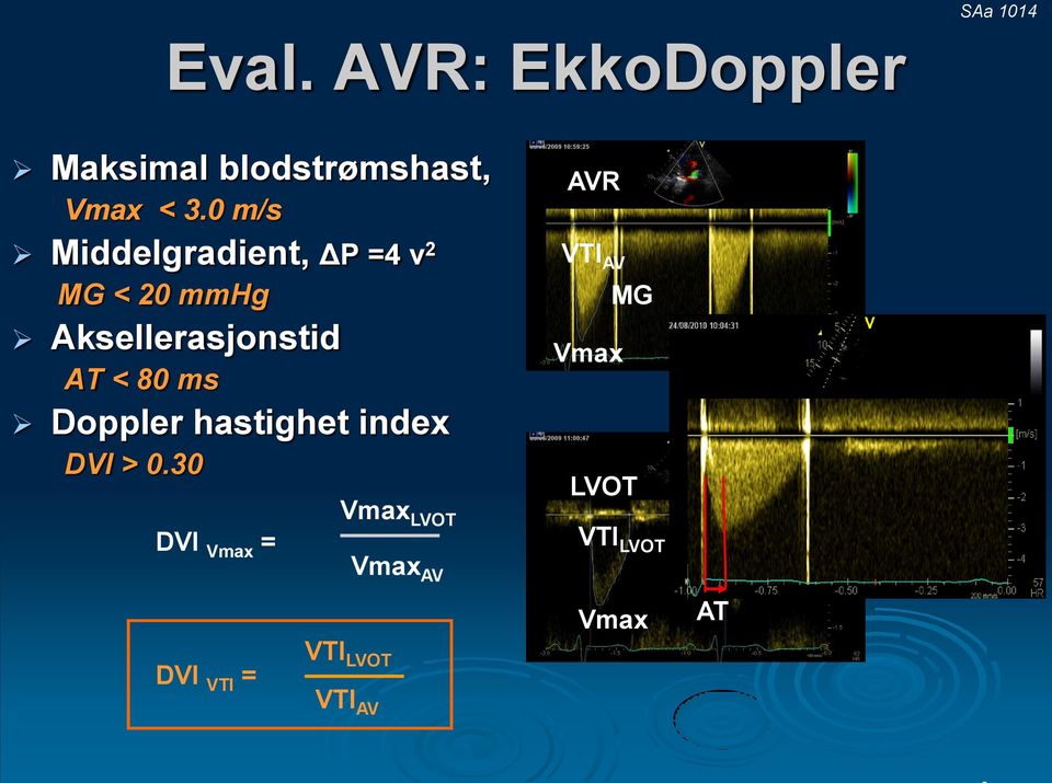 < 80 ms Doppler hastighet index DVI > 0.