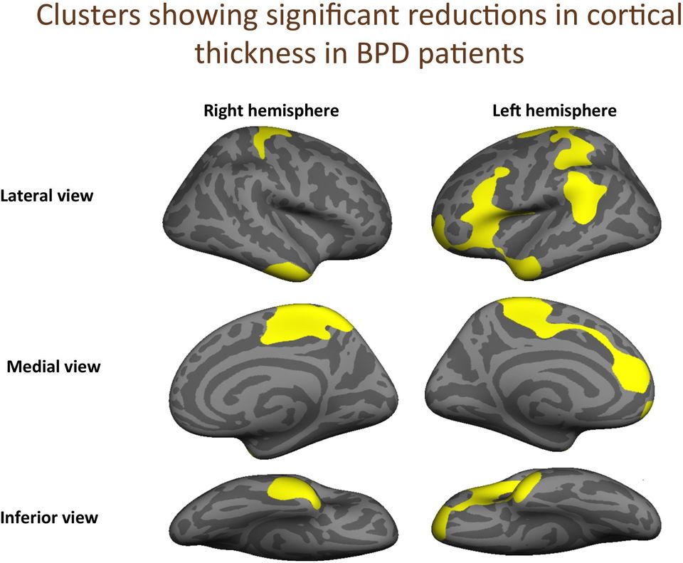 BPD pa8ents Right hemisphere Le?