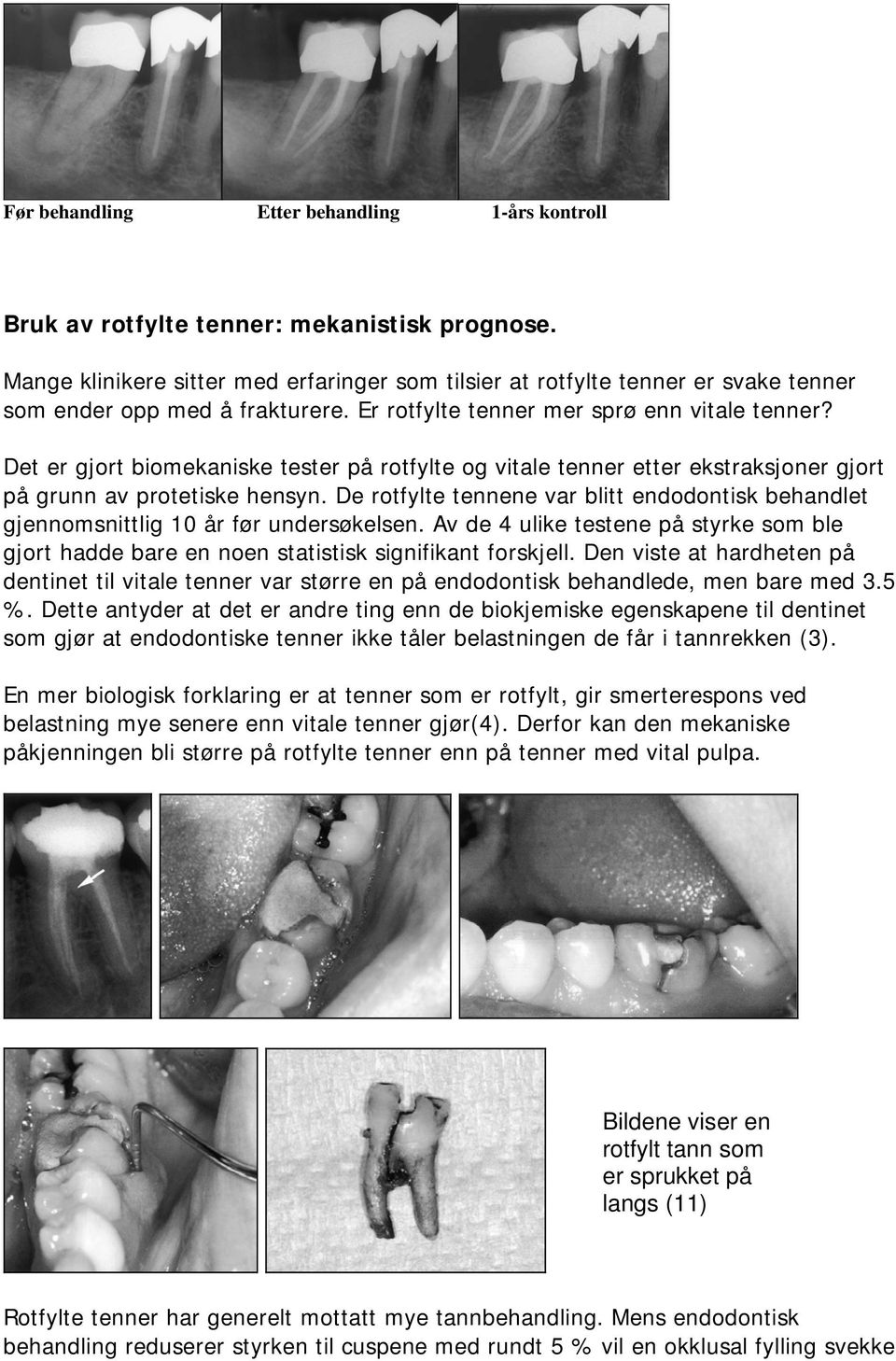 Det er gjort biomekaniske tester på rotfylte og vitale tenner etter ekstraksjoner gjort på grunn av protetiske hensyn.