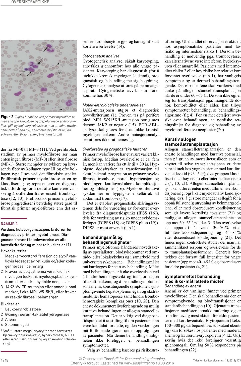 Molekylærbioliske undersøkelser Figur 2 Typisk blodbilde ved primær myelofibrose med anisopoikilocytose dråpeformede erytrocytter (kort pil), leukoerytroblastose med umodne myelene celler (lang pil),