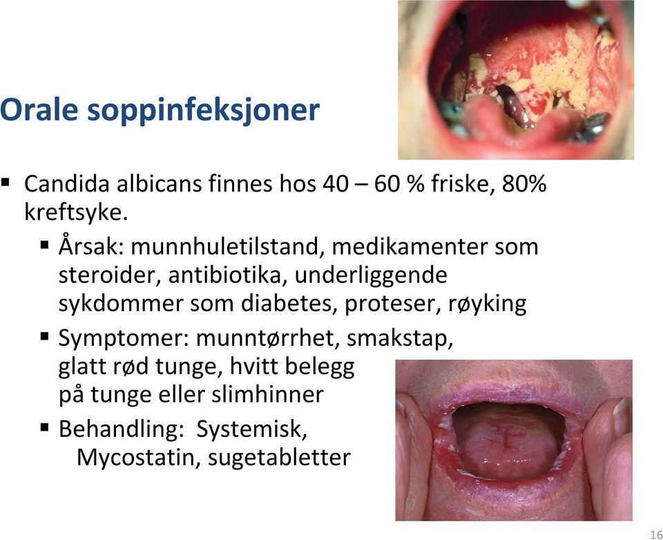 sykdommer som diabetes, proteser, røyking Symptomer: munntørrhet, smakstap, glatt rød