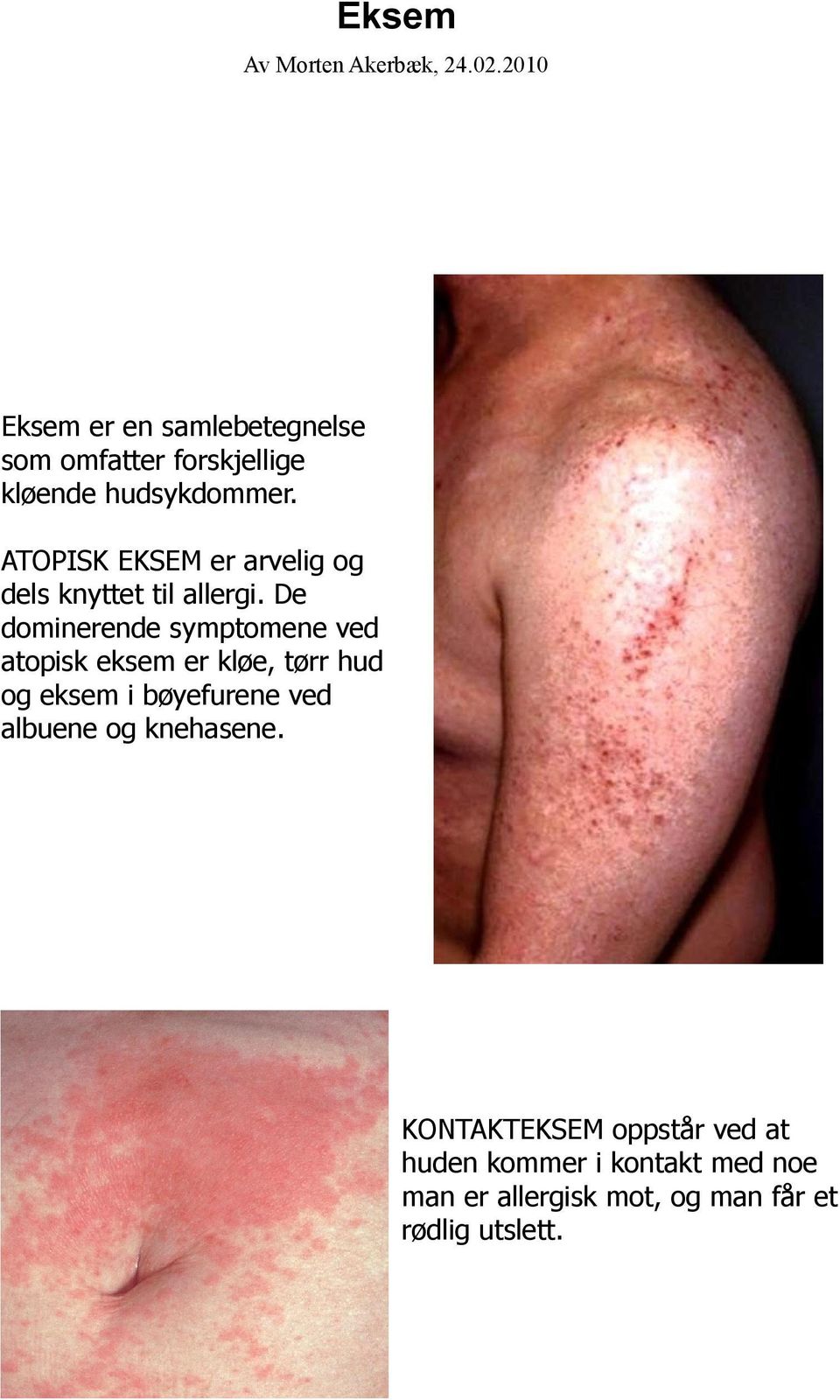 ATOPISK EKSEM er arvelig og dels knyttet til allergi.