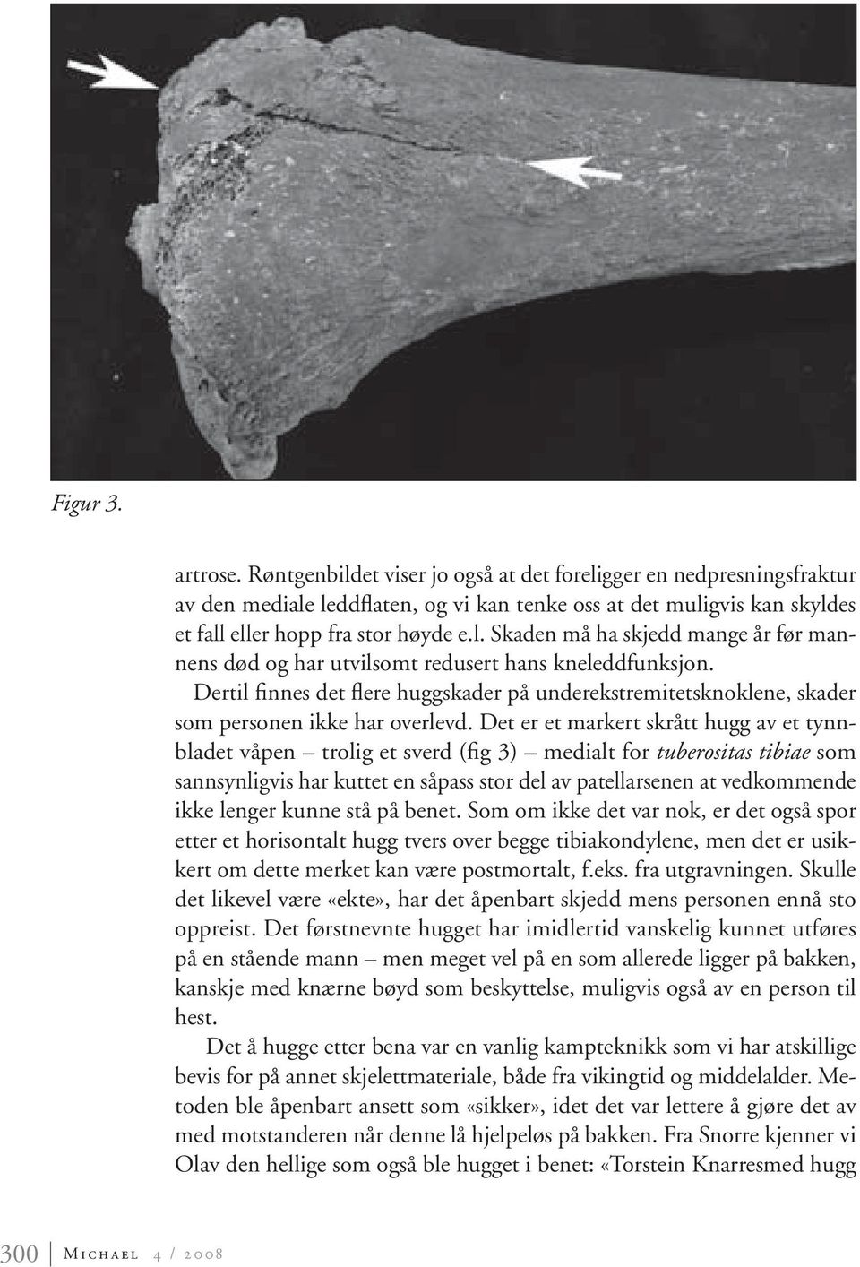 Det er et markert skrått hugg av et tynnbladet våpen trolig et sverd (fig 3) medialt for tuberositas tibiae som sannsynligvis har kuttet en såpass stor del av patellarsenen at vedkommende ikke lenger