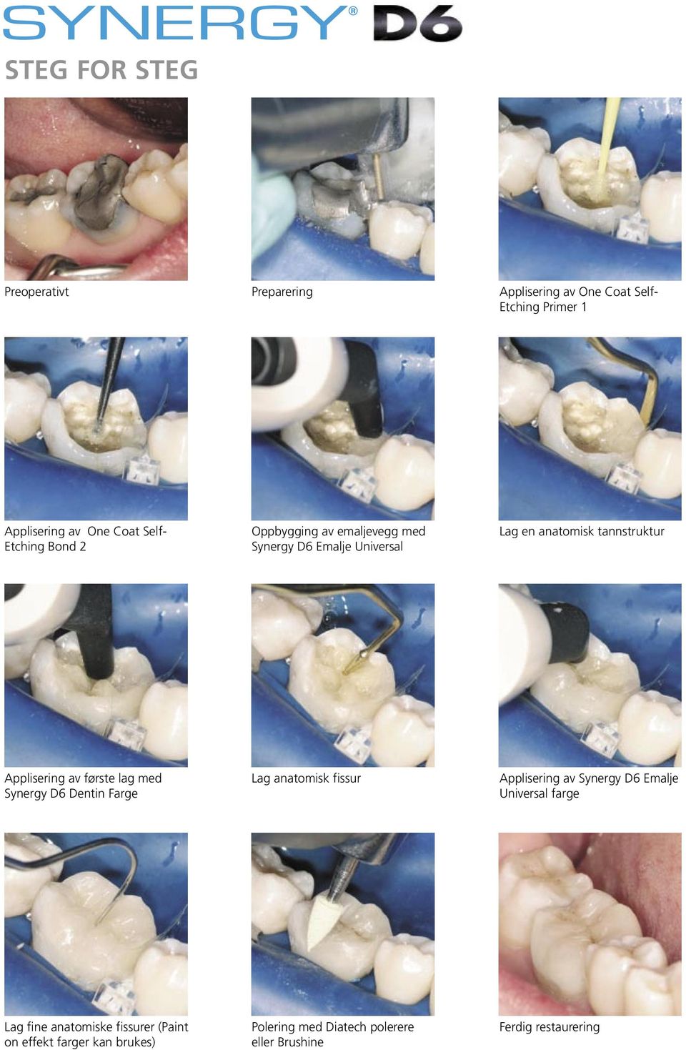 av første lag med Synergy D6 Dentin Farge Lag anatomisk fissur Applisering av Synergy D6 Emalje Universal farge Lag