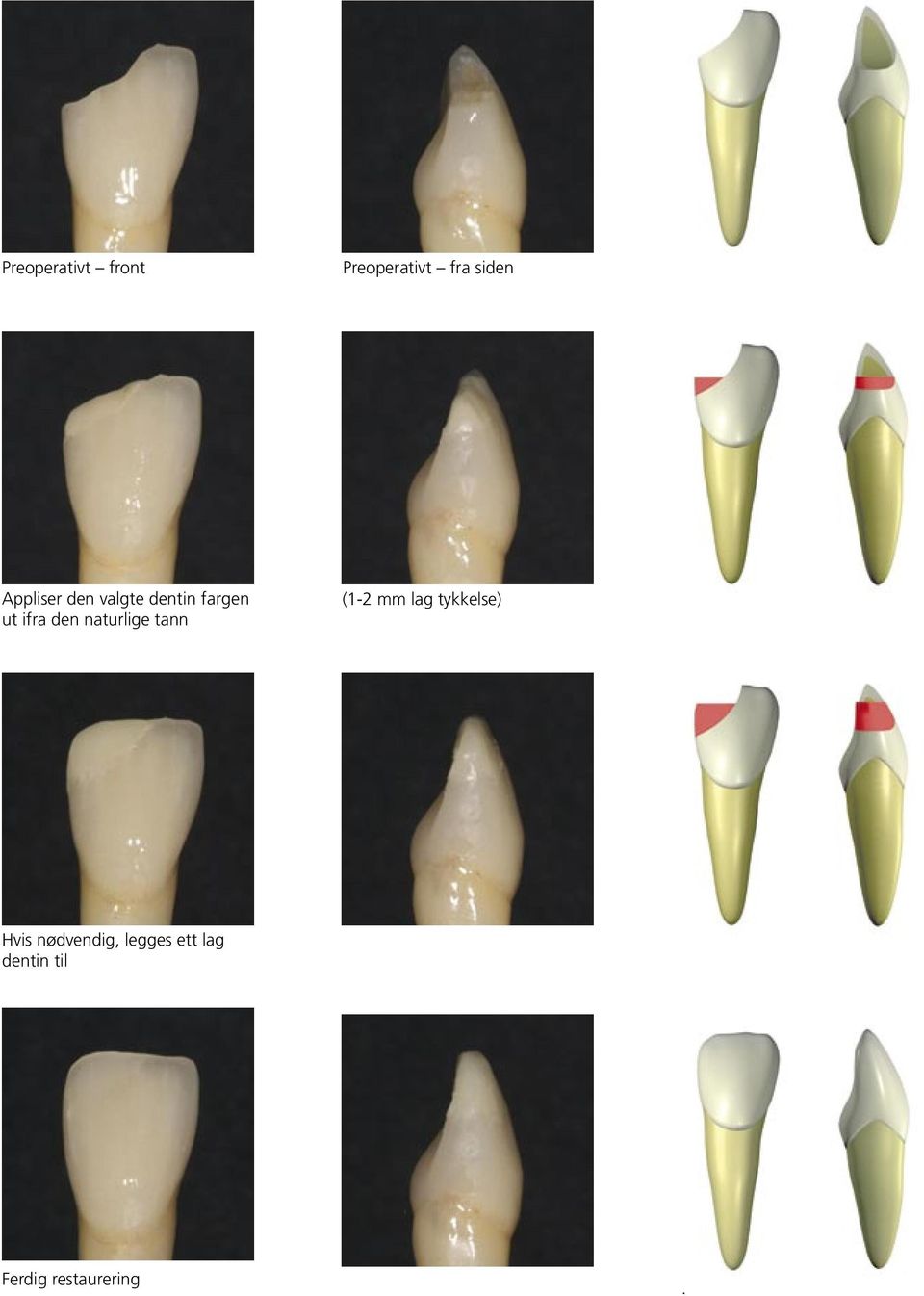naturlige tann (1-2 mm lag tykkelse) Hvis