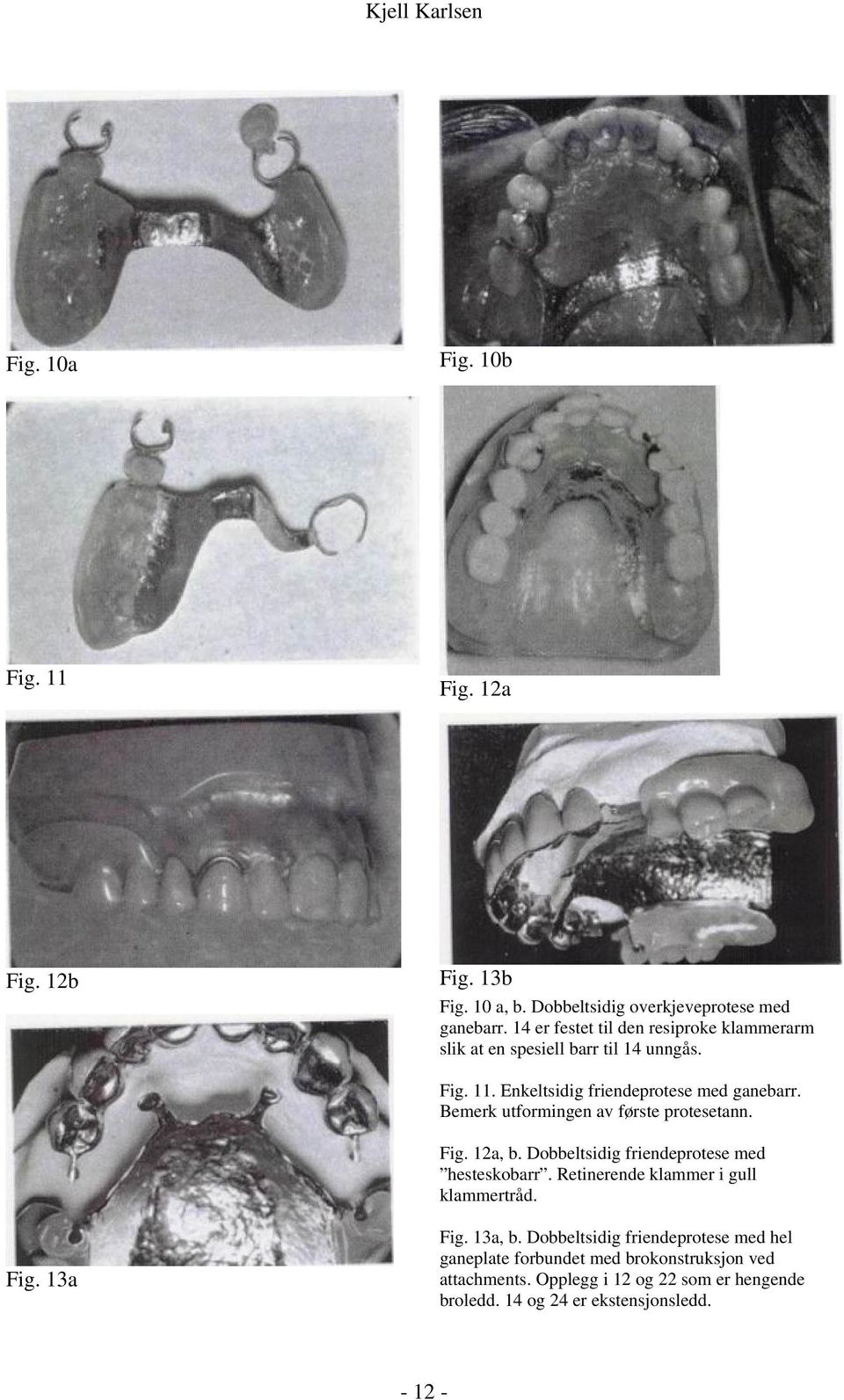 Bemerk utformingen av første protesetann. Fig. 12a, b. Dobbeltsidig friendeprotese med hesteskobarr. Retinerende klammer i gull klammertråd. Fig. 13a Fig.