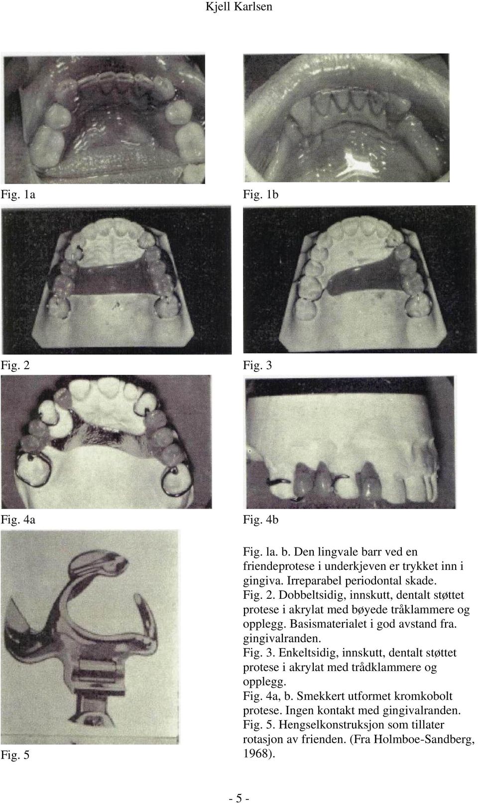 Basismaterialet i god avstand fra. gingivalranden. Fig. 3. Enkeltsidig, innskutt, dentalt støttet protese i akrylat med trådklammere og opplegg. Fig. 4a, b.